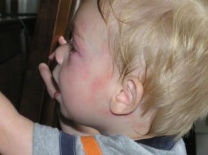 Emotional Roller Coaster of Life with Food Allergies - Post-Peanut Butter