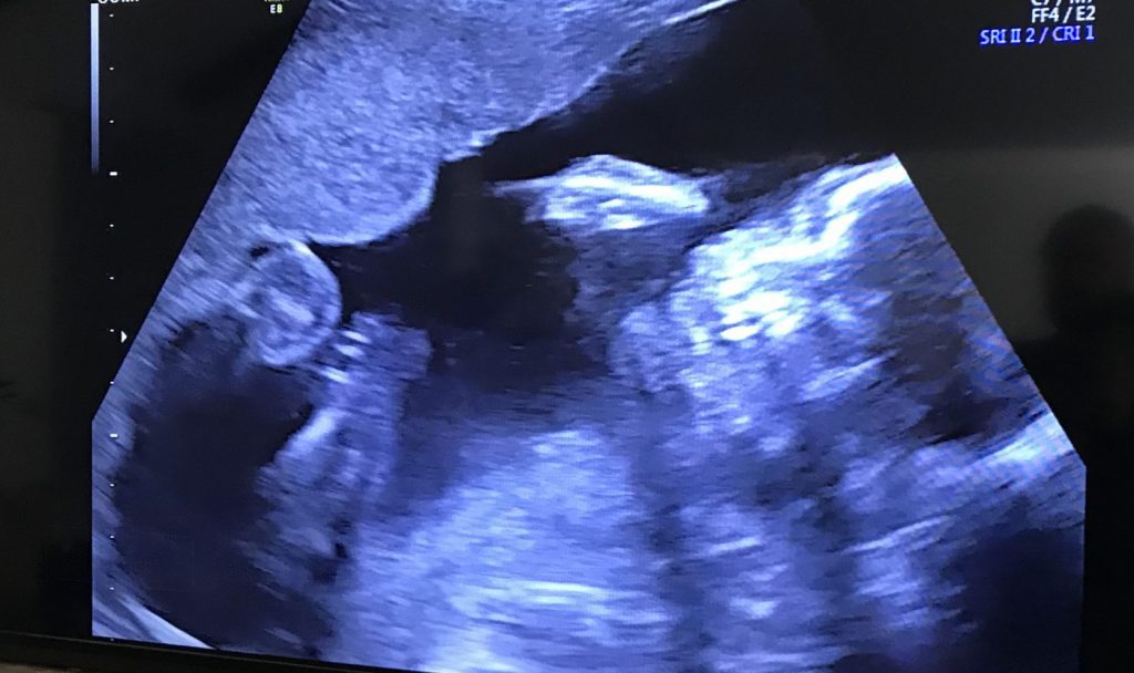 secondary infertility