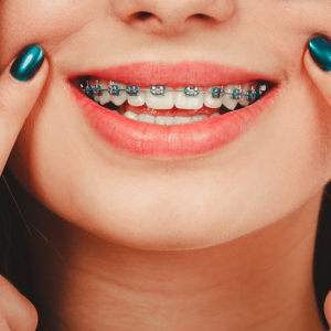 braces- top dental products for kids