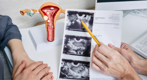 uterine fibroids